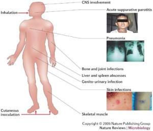 Melioidosis